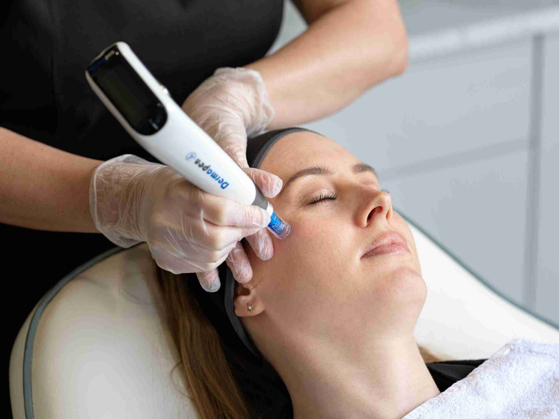 Treating Stretch Marks Naturally The Dermapen Solution
