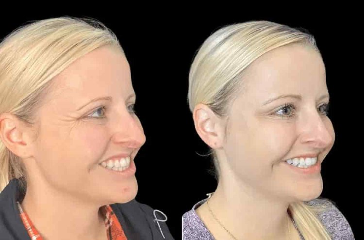 Affordable Luxury with the Best Plastic Surgeon in Dubai for Botox