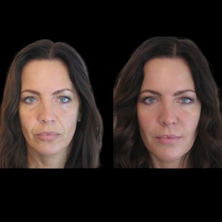 jawline-fillers