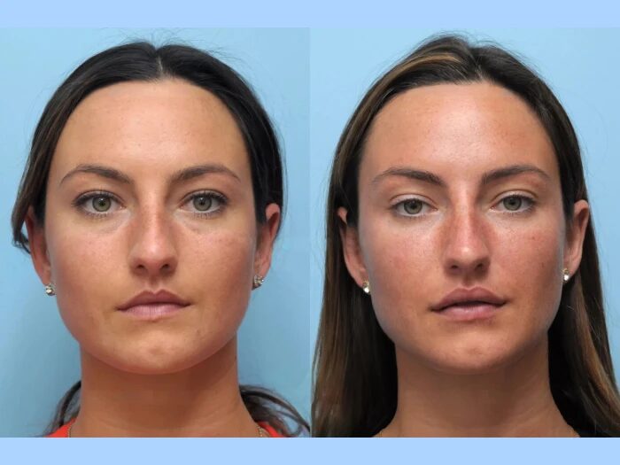 Find Confidence Again with the Best Plastic Surgeon in Dubai for Thread Lift