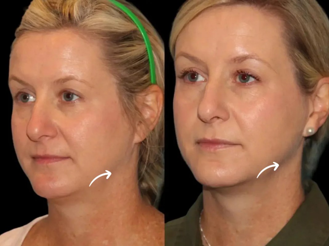 u3683-H2-Sculptra