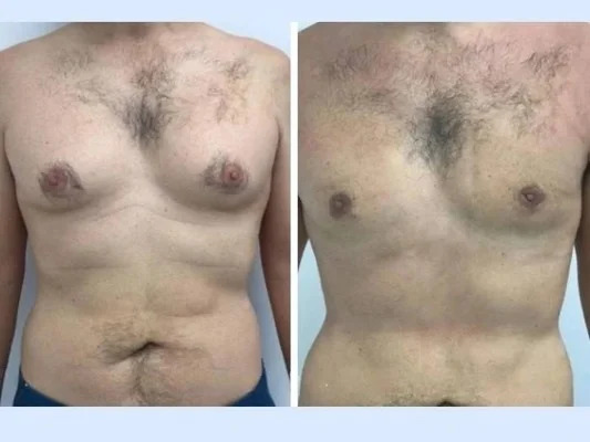 u3696-gynecomastia-in-dubai