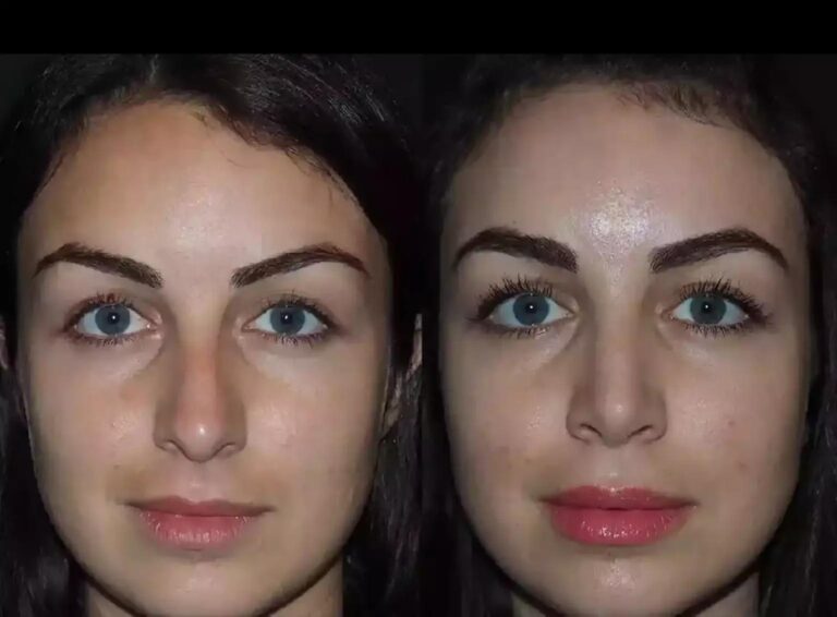 u3733-H-Rhinoplasty-15_11zon