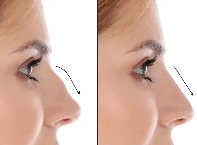 u3733-Rhinoplasty-in-dubai