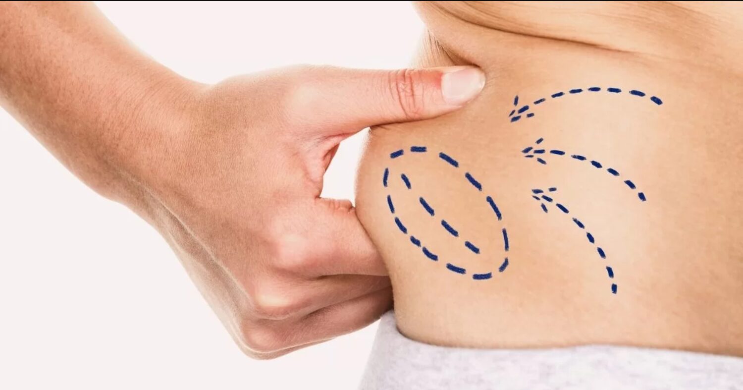 u3835-Best-Liposuction-Surgery-in-Dubai