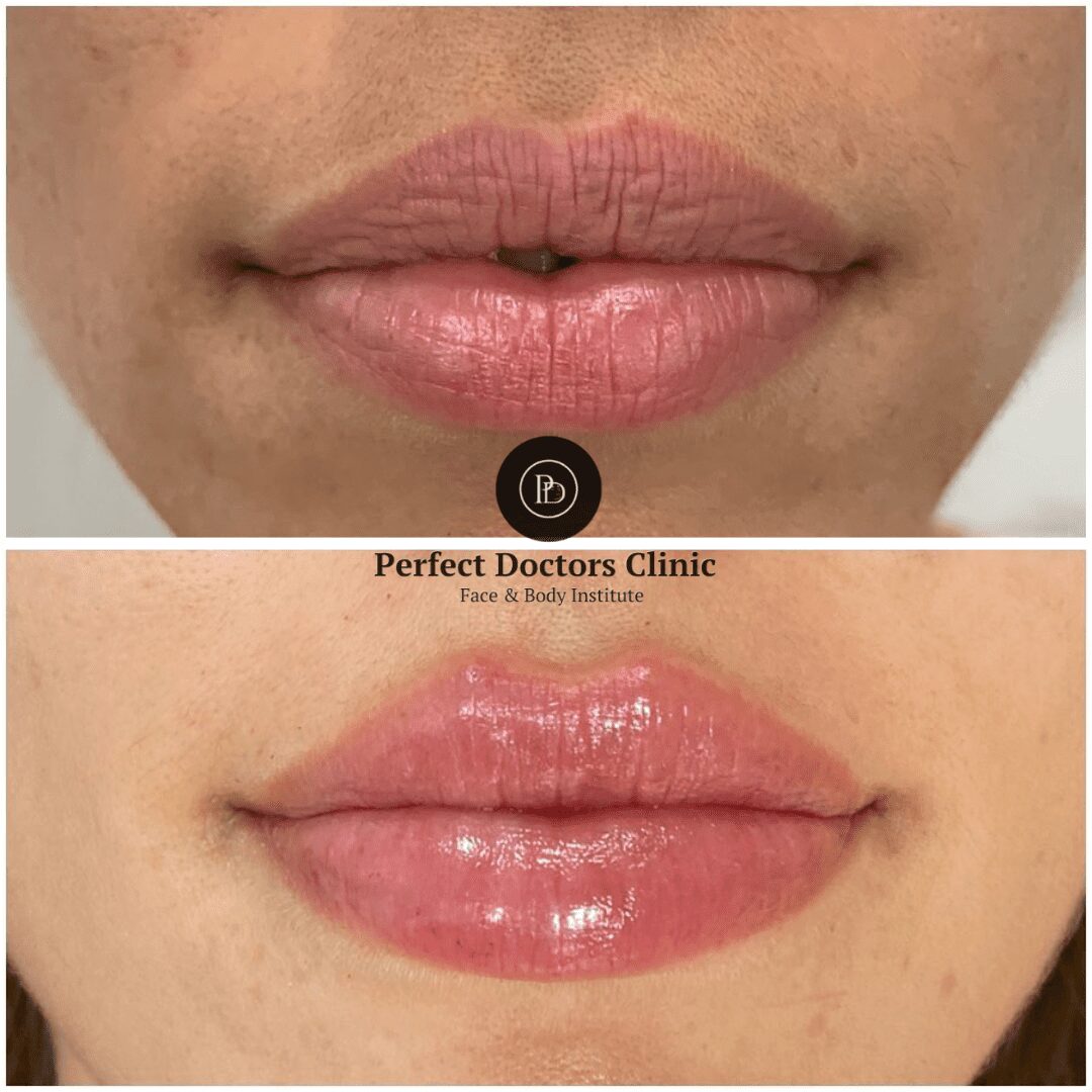 u3881-Copy-of-lip-filler-6