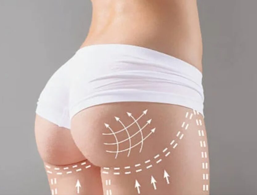 u3886-liposuction