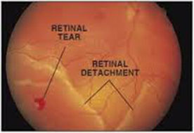 u3926-RETINAL-DETACHMENT-2
