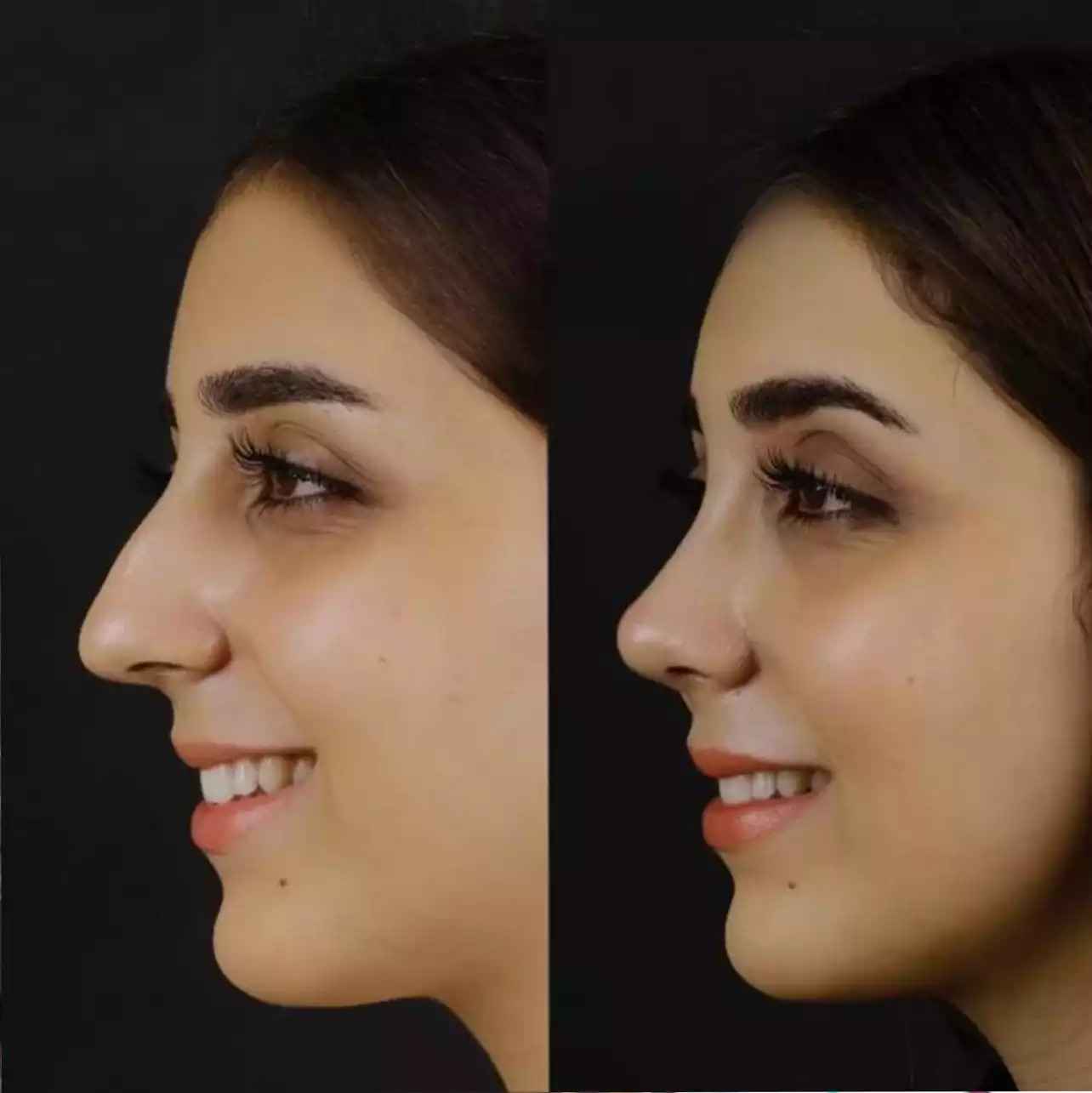 H-Rhinoplasty4-copy_11zon