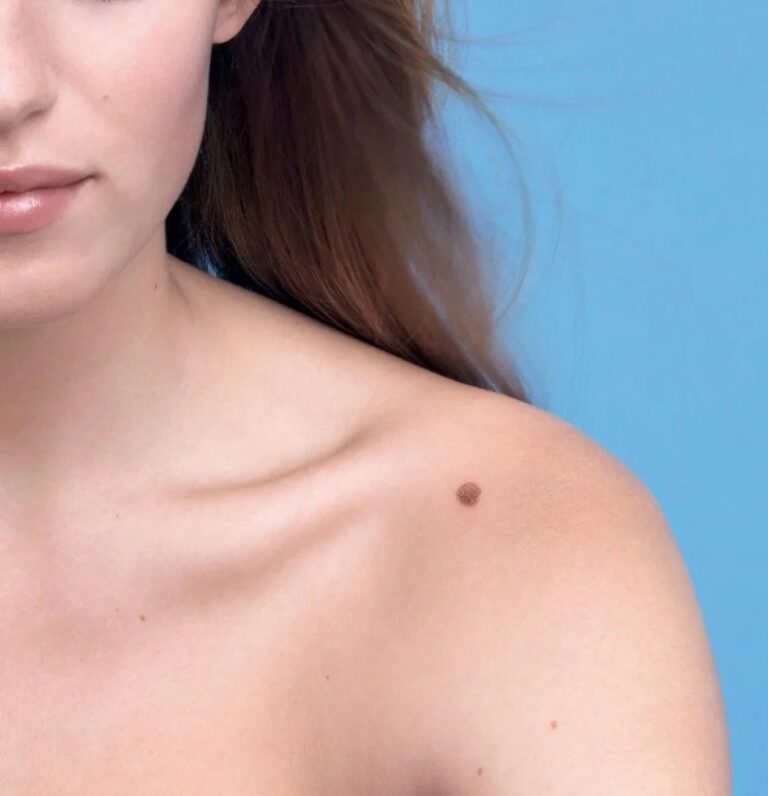 u3700-Can-Early-Moles-Treatment-Stop-Cancerous-Cells-From-Spreading