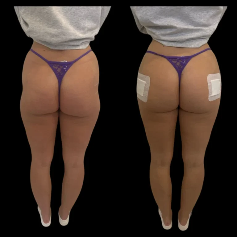 H2-non-surgical-Butt-Lift