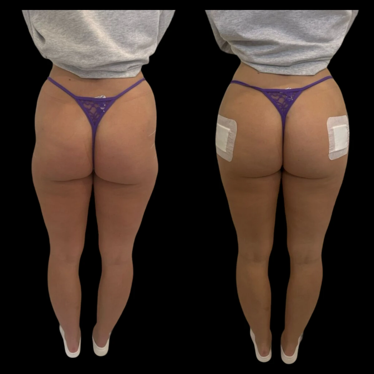 H2-non-surgical-Butt-Lift