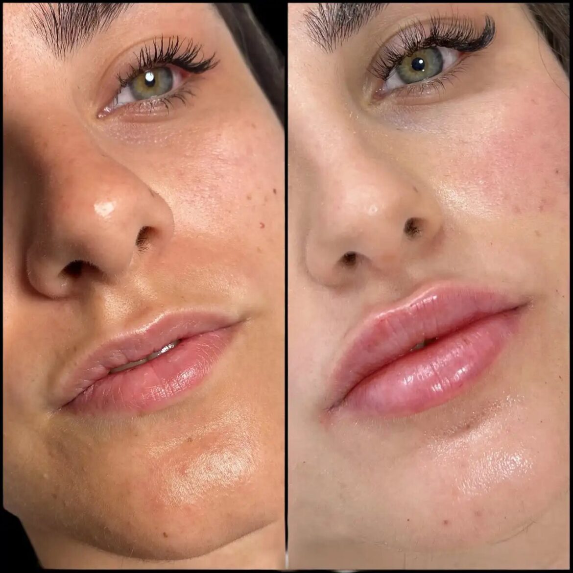 H8-lip-fillers-1170x1170-1