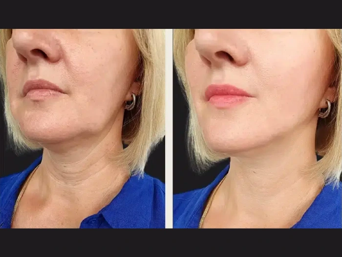 PRP-Treatment-in-Dubai-