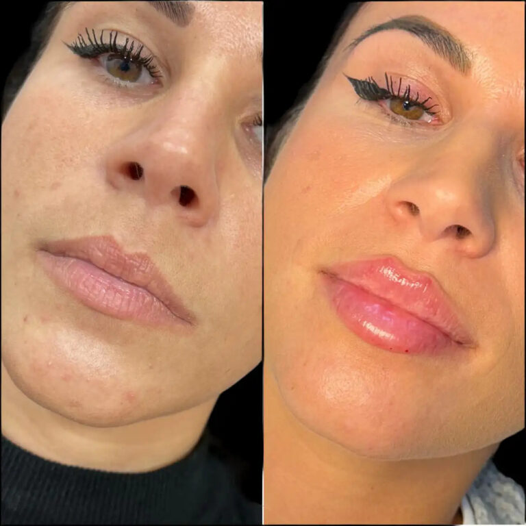 H6-lip-fillers-2