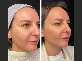 Mesotherapy-in-Dubai-1