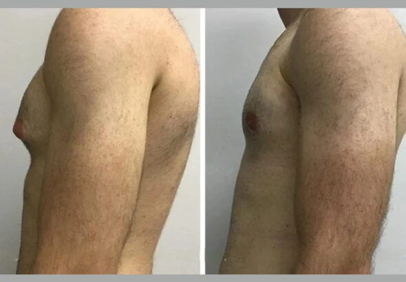 h9-gynecomastia