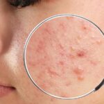 Acne-Treatment-in-Riyadh