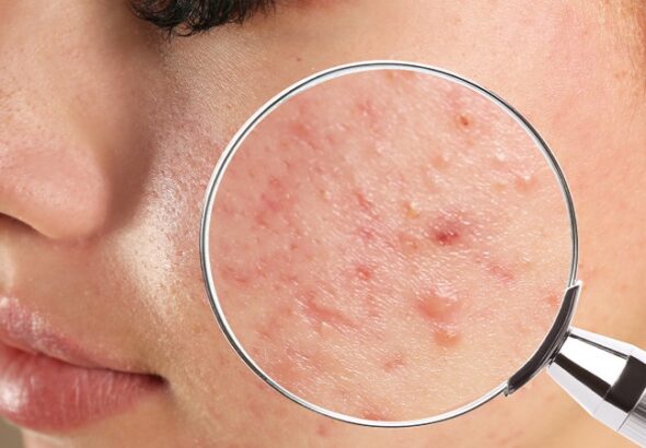 Acne-Treatment-in-Riyadh