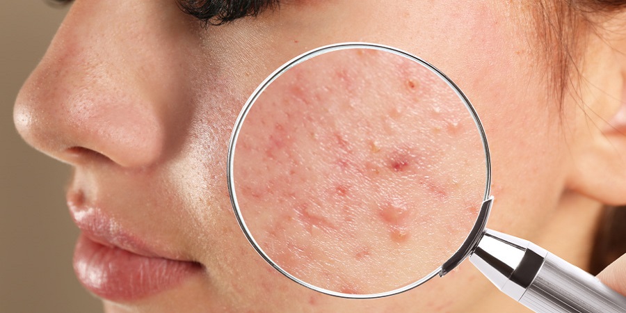 Acne-Treatment-in-Riyadh