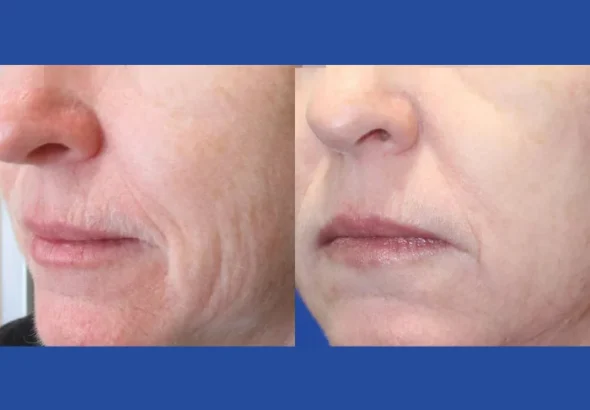 H3-fractional-rf-microneedling-1