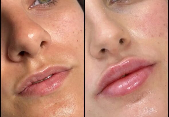 H8-lip-fillers-1170x1170-3