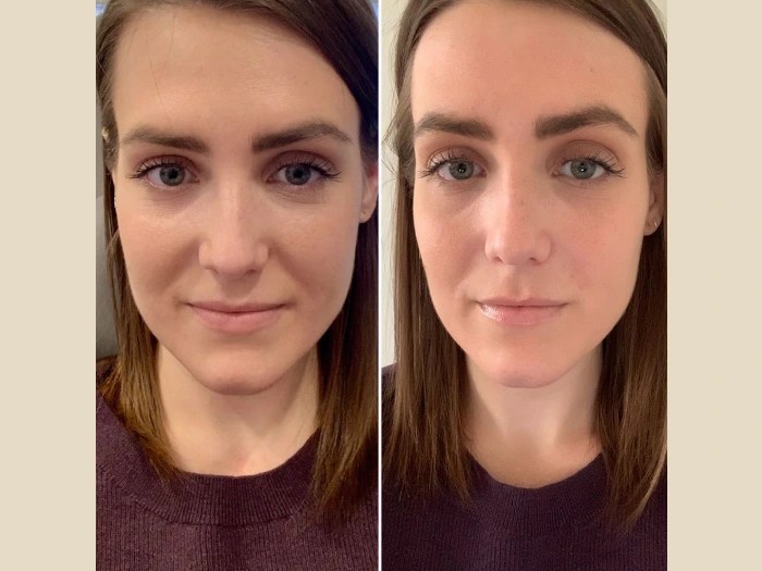 PRP-Treatment-in-Dubai-3