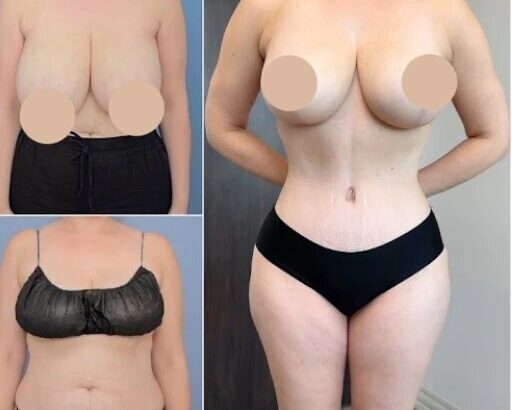 360-body-lift-results