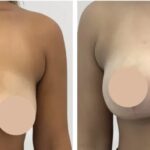 H1-Breast-reduction-1