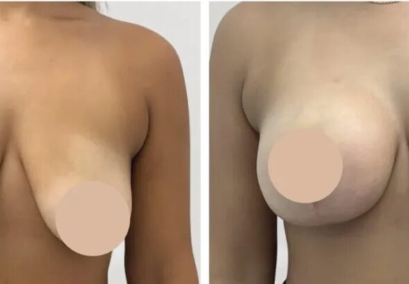 H1-Breast-reduction-1