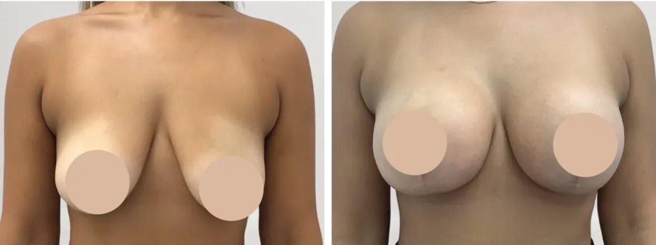 H1-Breast-reduction-1