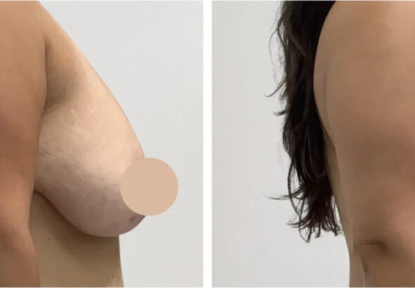 H12-Breast-Lift