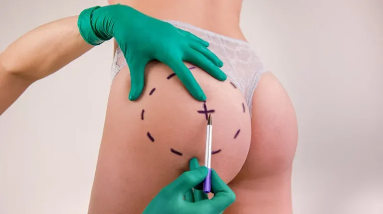 Non-Surgical-Buttock-Augmentation