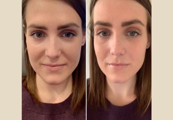 PRP-Treatment-in-Dubai-3