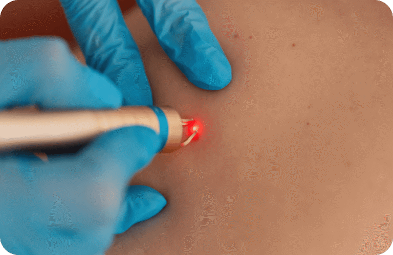 Skin-Tags-Removal-in-Dubai