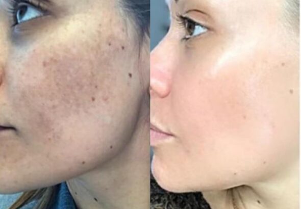 Cosmelan-Pigmentation-Treatment-in-Altrincham