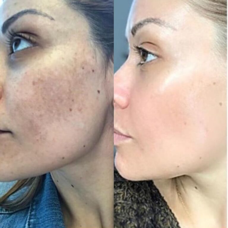 Cosmelan-Pigmentation-Treatment-in-Altrincham