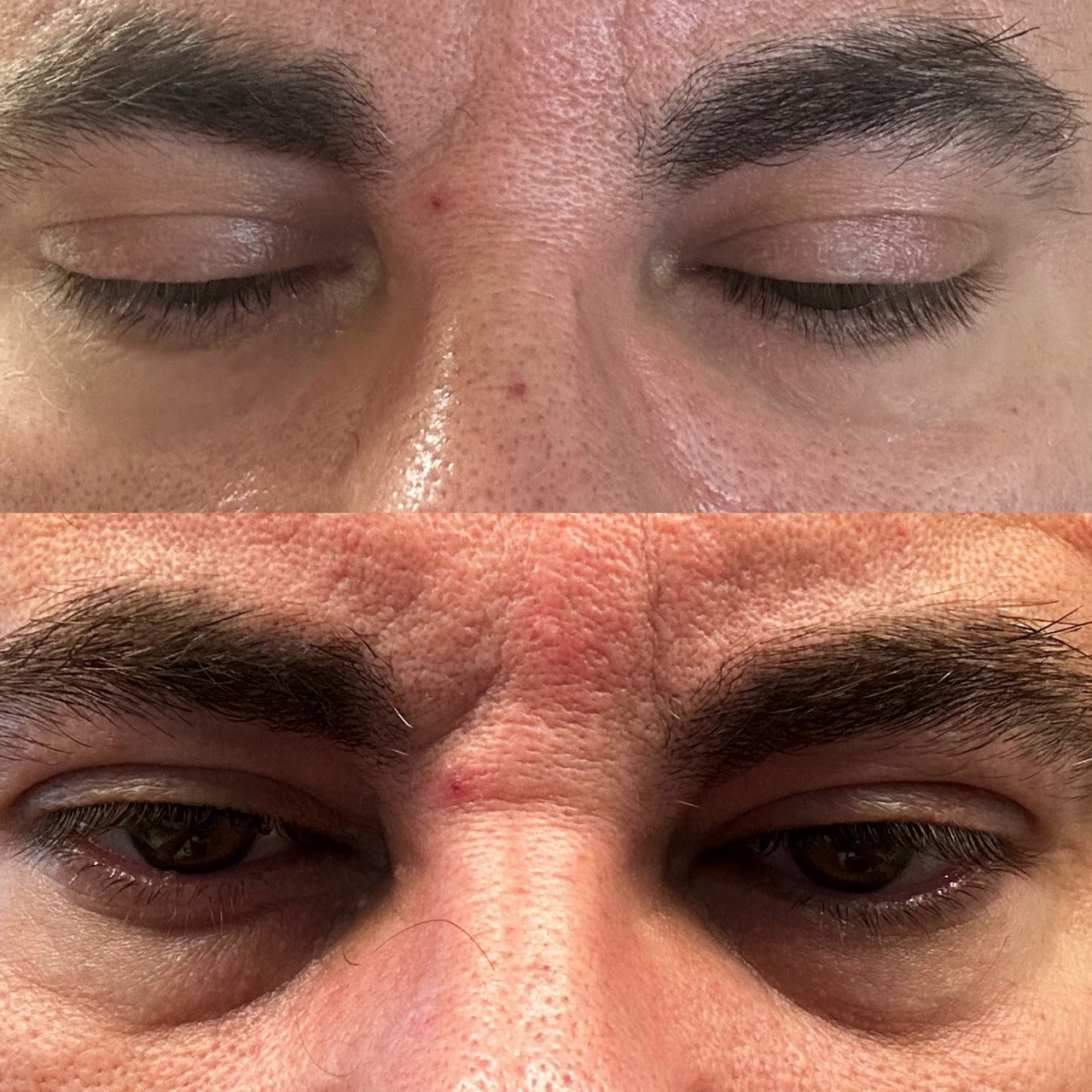 Eye-Bag-Removal-Techniques-You-Should-Know-About