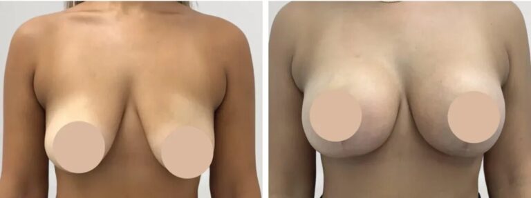 H1-Breast-reduction-1