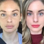 H11-RF-Microneedling-1