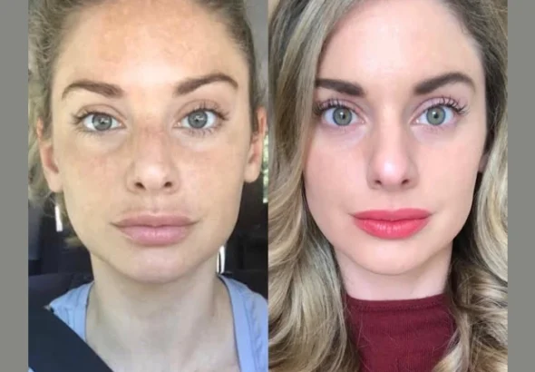 H11-RF-Microneedling