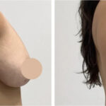 H12-Breast-Lift-1
