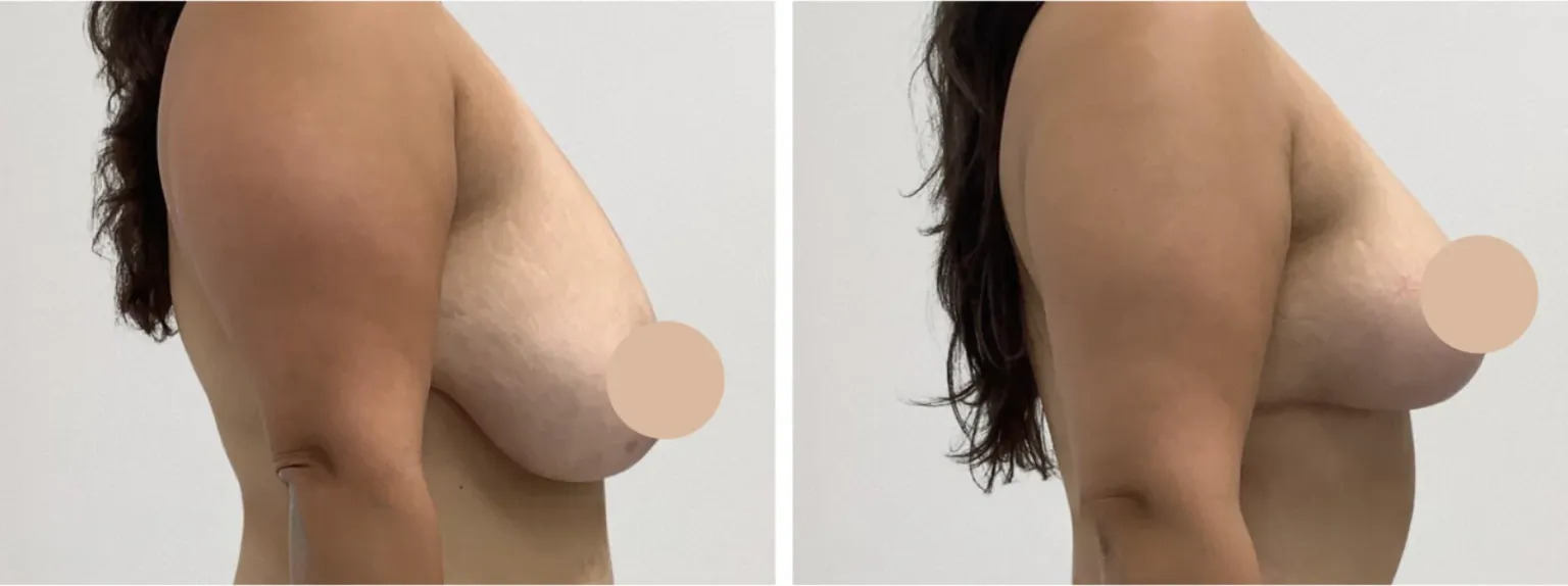 H12-Breast-Lift-1