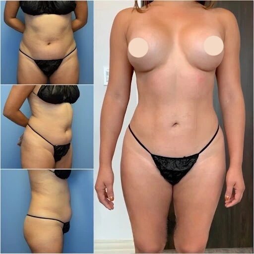 Liposuction-pictures-1