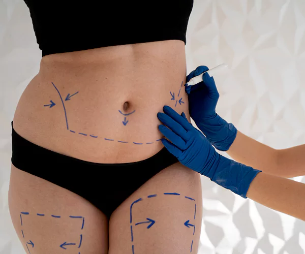 Liposuction