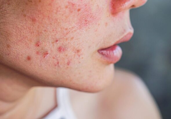 acne-removal-treatment-dubai-1024x683-1