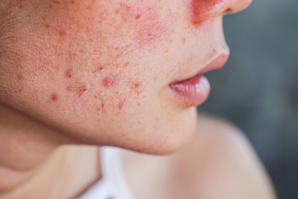 acne-removal-treatment-dubai-1024x683-1