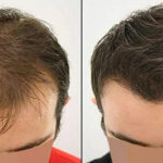 best-fue-hair-transplant-doctors-1-1024x539-copy-2