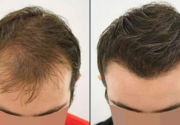 best-fue-hair-transplant-doctors-1-1024x539-copy-2