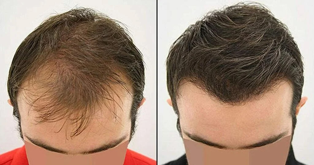 best-fue-hair-transplant-doctors-1-1024x539-copy-2